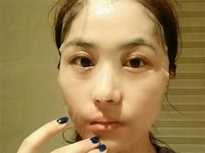 天天敷面膜为什么长痘痘