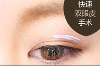 双眼皮哪种类型好看