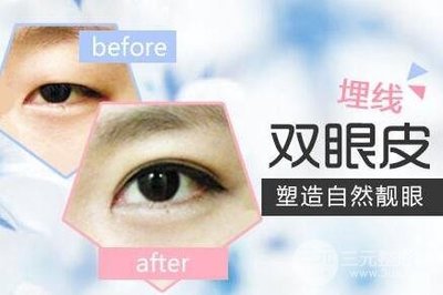 双眼皮埋线出血