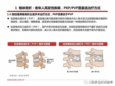 脊椎骨折pvp手术多少钱