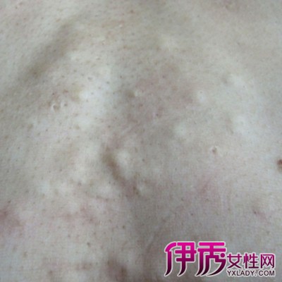 脂囊瘤怎么治疗