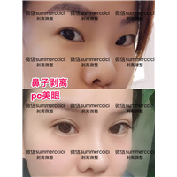 双眼皮 价格