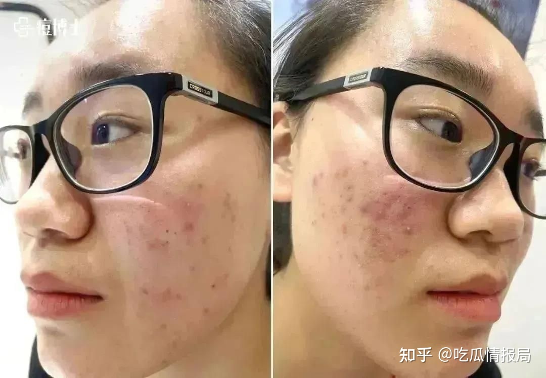 30多岁 右脸长痘痘