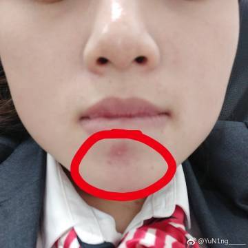 鼻子内壁长了一个痘痘