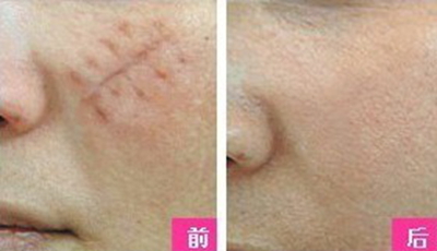 疤痕软化针的价格