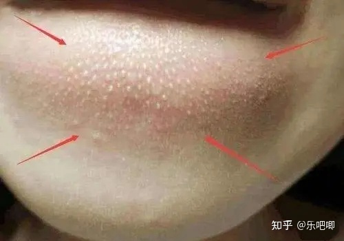 嘴巴上面的痘痘疼