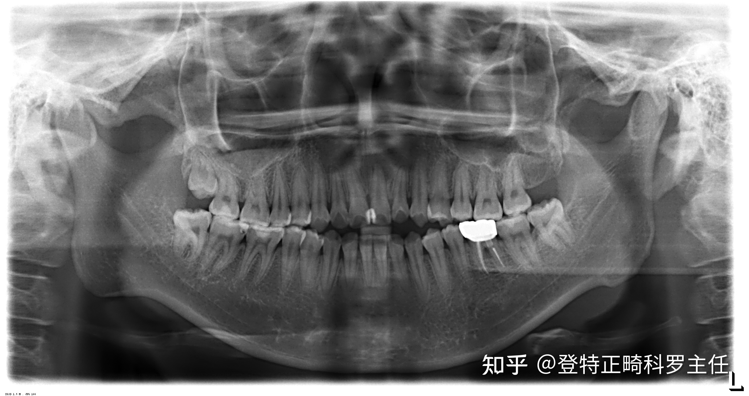 拔牙多久能怀孕