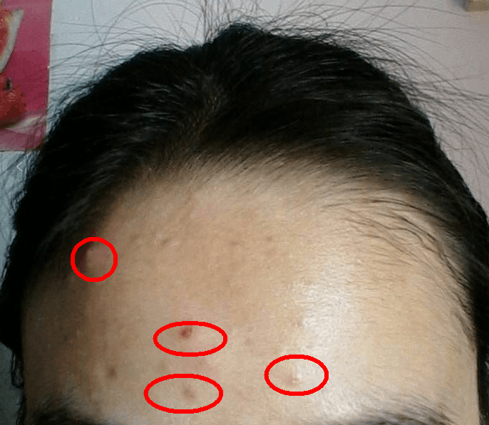 用什么泡水排痘痘