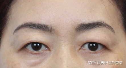 下眼皮凹陷修复哪里好