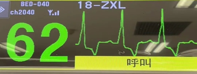 心率低到多少需要装起搏器