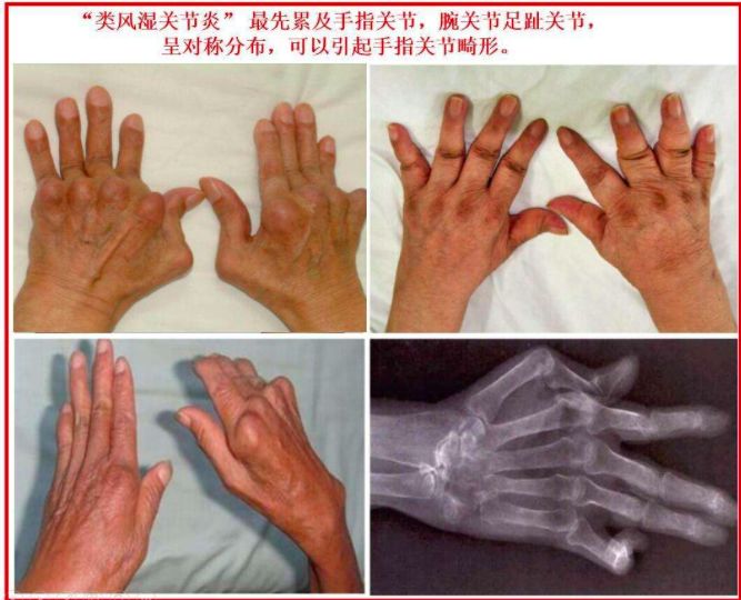 手指关节炎怎么治疗