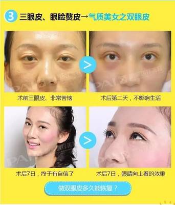 割双眼皮在哪里