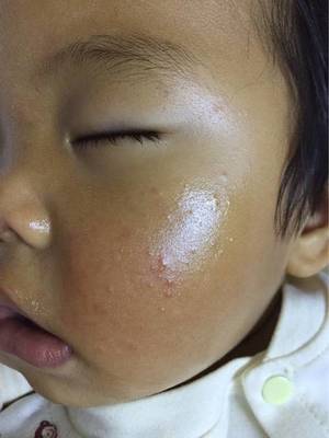 脸上油还发红长痘痘