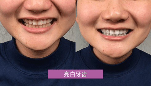 牙齿洁牙对比