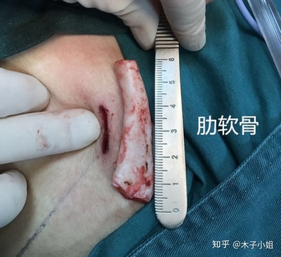半肋骨隆鼻有后遗症吗