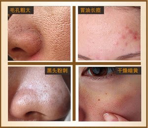 毛孔粗大有黑头粉刺怎么办