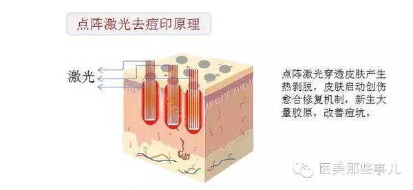 痘痘痘坑痘疤怎么办