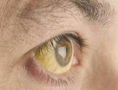 正常眼睛怎么发黄