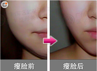 整形瘦脸针注射多少钱