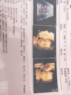 怀孕四个月怎么看男女