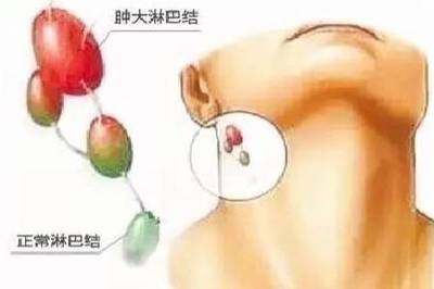 一岁宝宝耳后淋巴结肿大怎么办