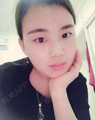 瘦脸针几天有感觉