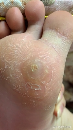 脚上长疣怎么治疗