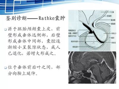 经鼻蝶微创垂体囊肿手术费用多少钱