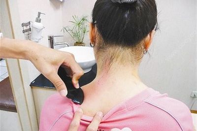 孕妇可以刮背吗