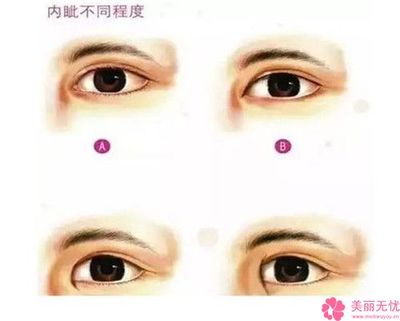 双眼皮忌口多久