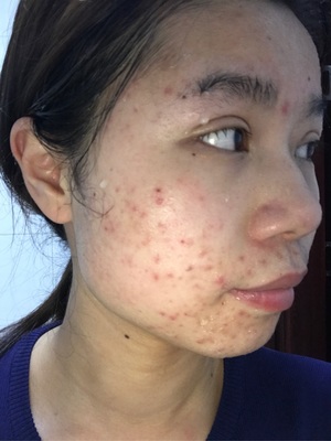 腮两边老长痘痘是什么原因
