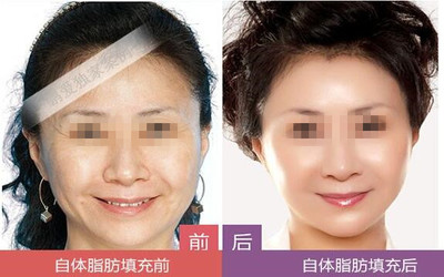 填充除皱