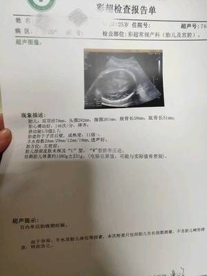 32周胎儿