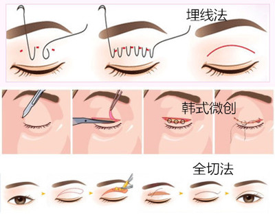 双眼皮哪种类型好看