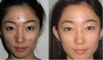 脸上有痘痘可以敷什么