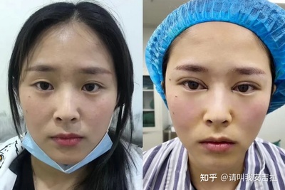 割了双眼皮后特后悔