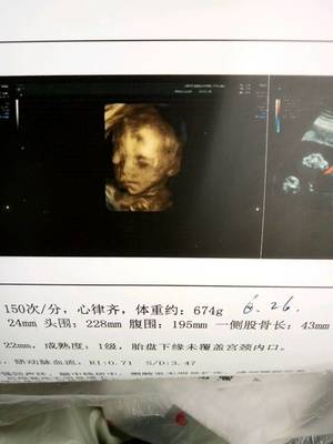 怀孕6个多月胎动少正常吗