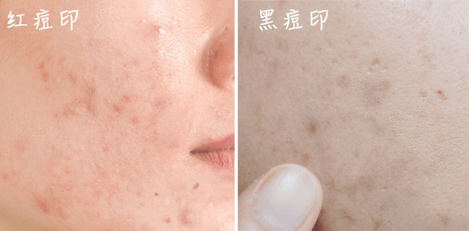 痘印和痘疤