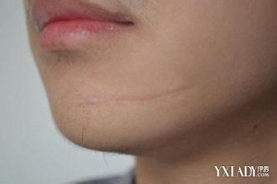 除疤痕的方法