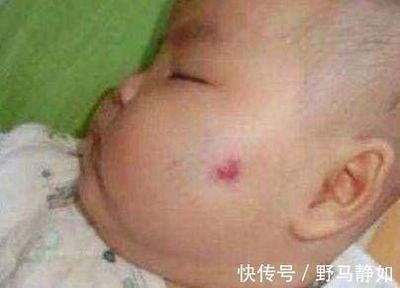 胎儿胎记是什么造成的