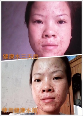 健康水 痘痘