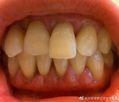 牙根出血是怎么回事