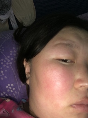 脸部发热是怎么回事