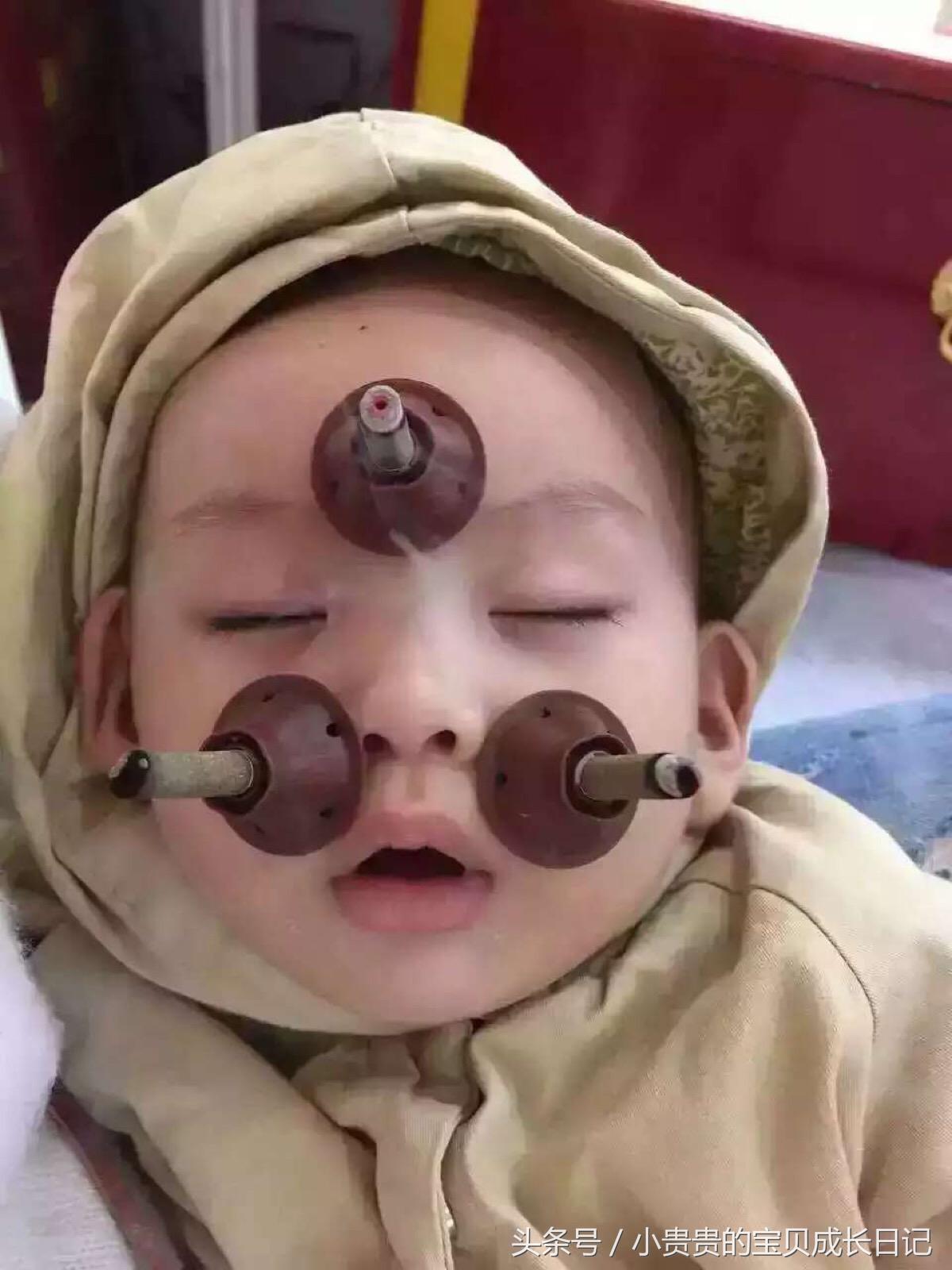 宝宝一个鼻孔流鼻涕