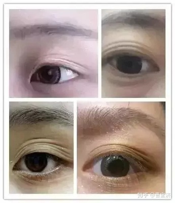老贴双眼皮贴会怎么样