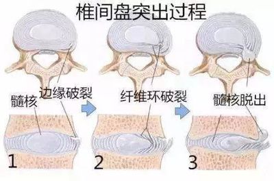 颈椎突出怎么治疗效果好