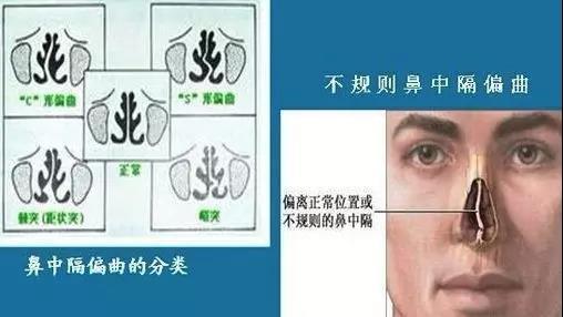 鼻中隔偏曲怎么治疗