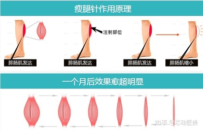 吸脂瘦腿效果如何
