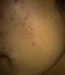 上海治痘痘8号
