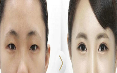 纳米双眼皮几天消肿